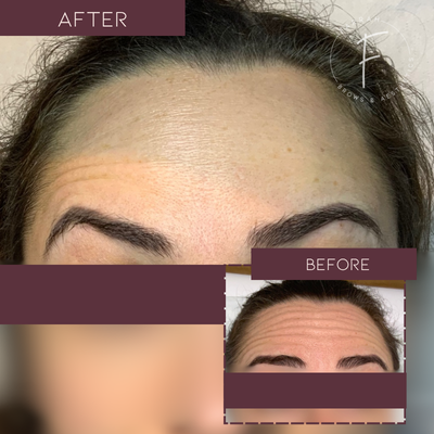 Botox-Farrah Brows