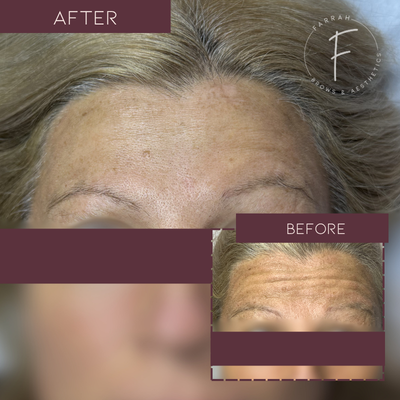 Botox-Farrah Brows