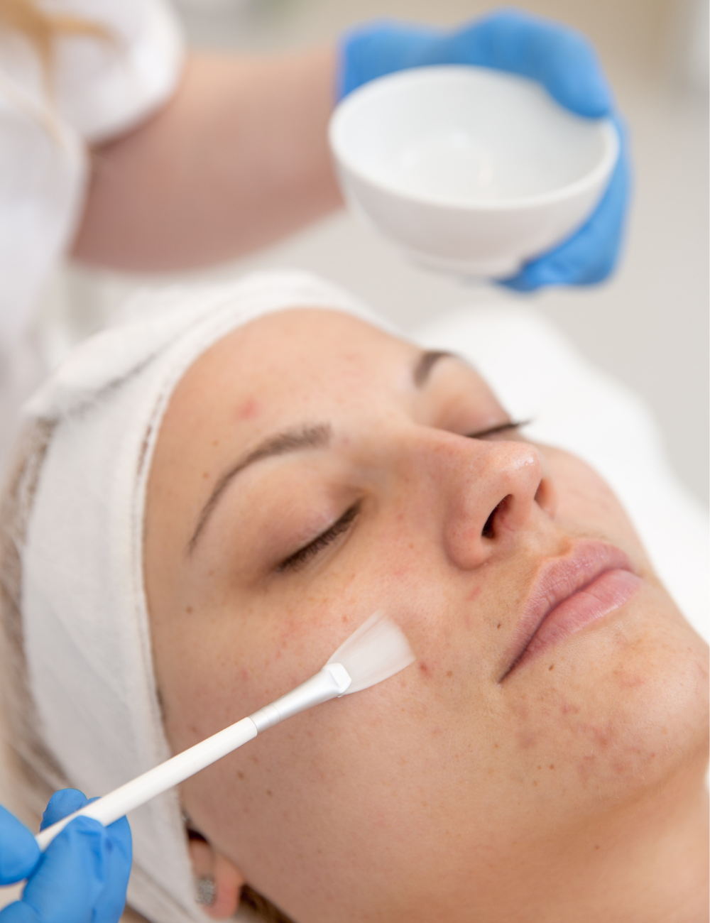Chemical Peel Treatment