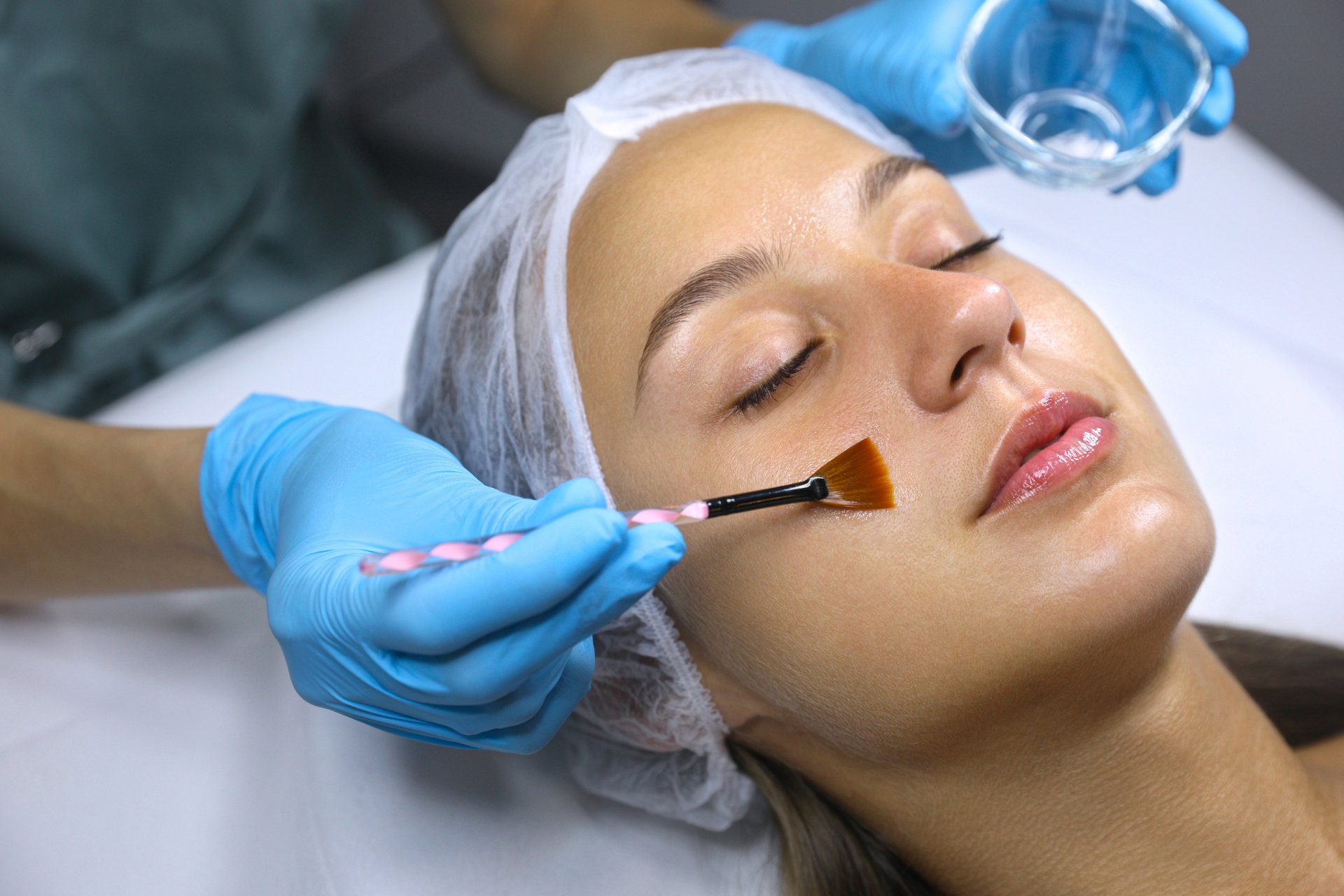 Chemical Peel Treatment