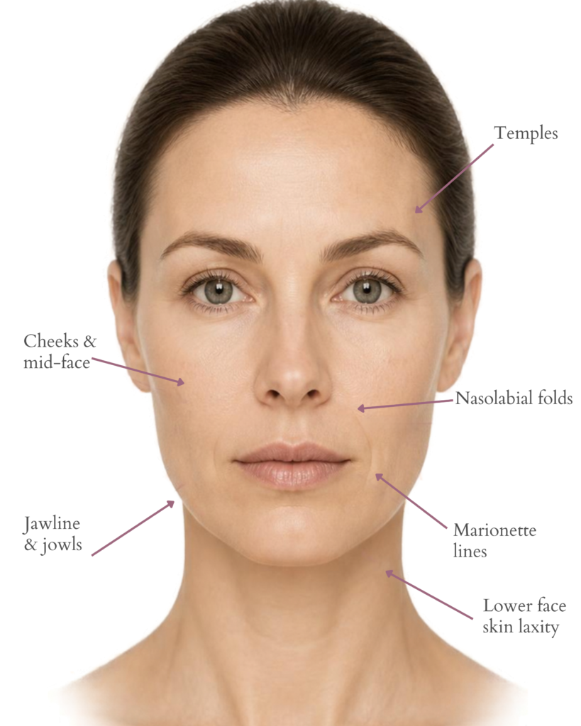 Treatment Areas of Sculptra